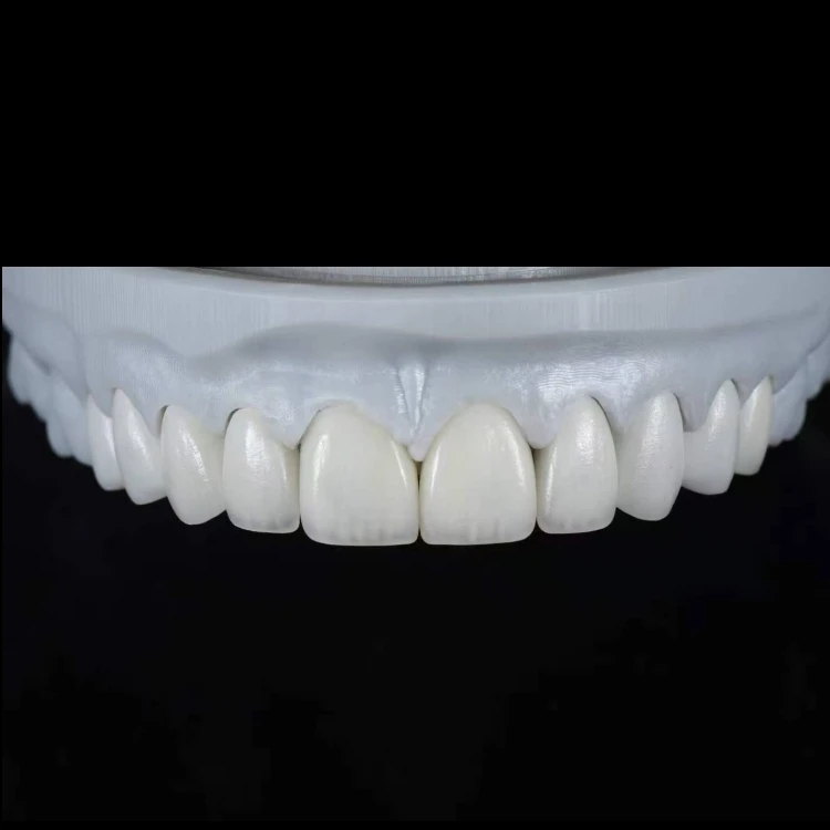 E.max veneer design for closing central diastema E.max veneer design for closing central diastema