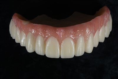 アクリル樹脂仮冠