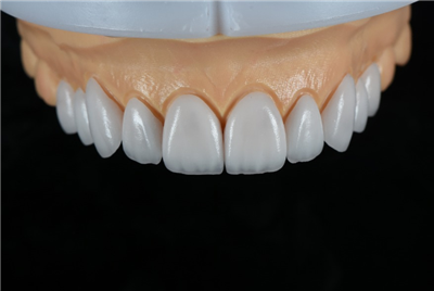 自然な見た目と審美的な Emax ベニア